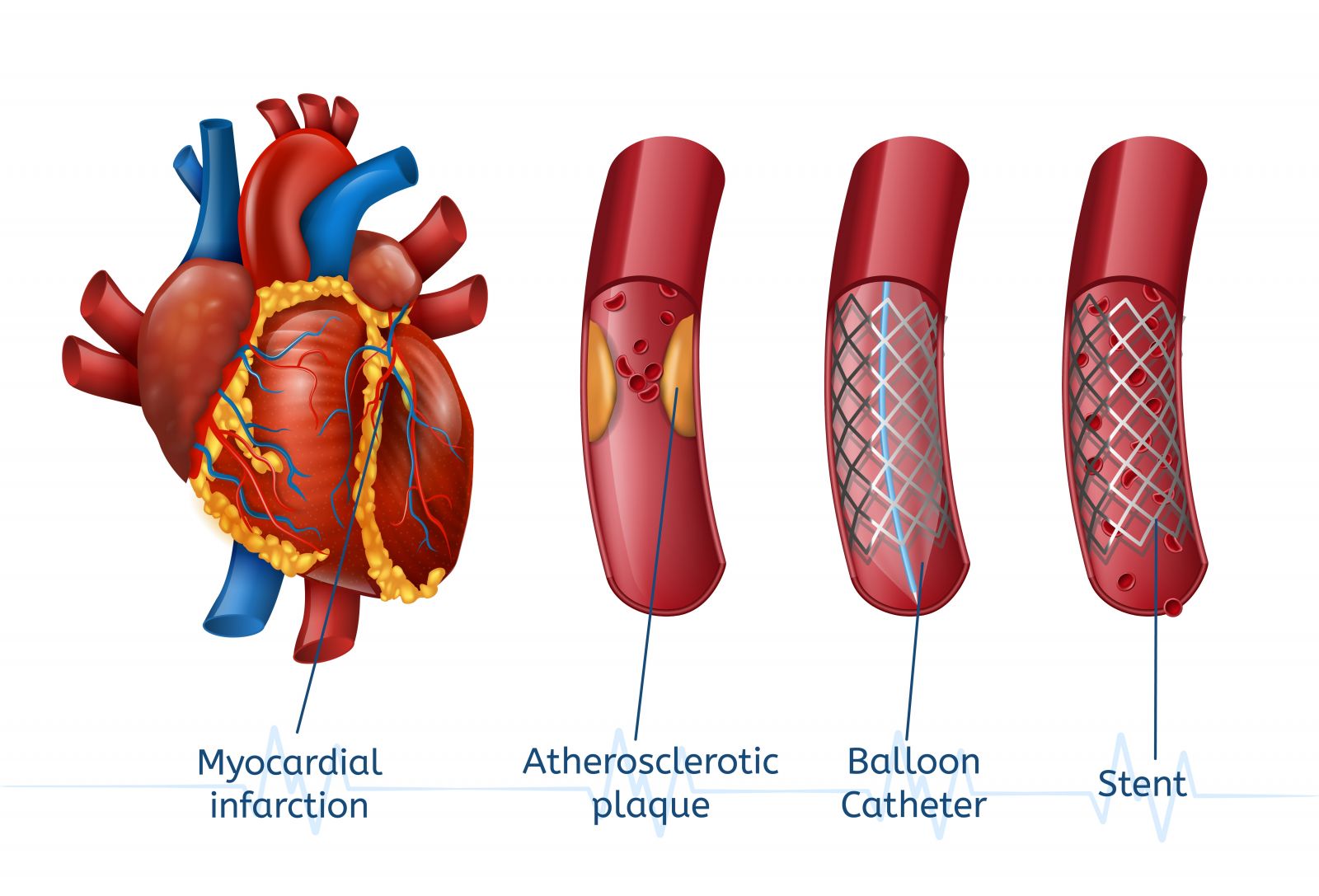 Angioplasty in Kissimmee FL and Poinciana, FL